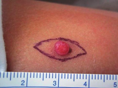 Paediatric melanoma 31 melanomas in Australia appears to parallel the decrease in the incidence noted in children and adolescents in the United States, but the peak incidence in Australia appears to