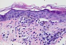 lesion on chest r/o NUB Old Adage: Lymphocytes