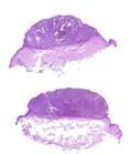 Spitzoid Malignant 29 9 Melanoma (SMM) Atypical Spitzoid Neoplasms # Age Gender Site