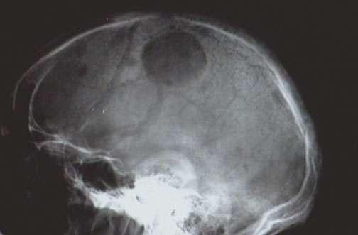 Figure 16.2 : The rounded "punched out" lesions of multiple myeloma appear as lucent areas of this skull radiograph Table 16.