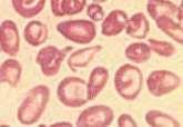 VARIATION IN SHAPE POIKILOCYTOSIS 1. Poikilocytes are pear-shaped RBC denoting destruction. Poikilocytosis caused by a defect in the formation of red cells.