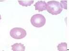 Crenated RBC may be produced in Blood smear which dries slowly. They are often found in various portions of the blood smear. 8.