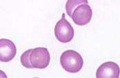 11. Teardrop cell (dacrocytes) is usually smaller than erythrocytes. Teardrop cell resemble tears.
