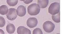 Schistocytes are red blood cell fragments and may occur in microangiopathic hemolytic anemia, uremia, severe burns, and hemolytic anemiacaused by physical agents, as in DIC ALTERATION IN ERYTHROCYTE