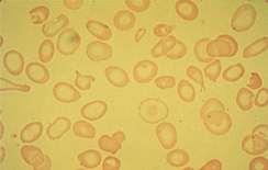 Figure: 6.1 Thalassemia major: The blood smear show hypochromic microcytic anemia in which targets cells, tear drops, and fragments are frequent.