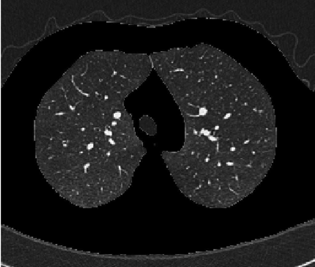 Hosseini MP et al. Computer-Aided Detection of COPD the lungs causing shortness of breath.