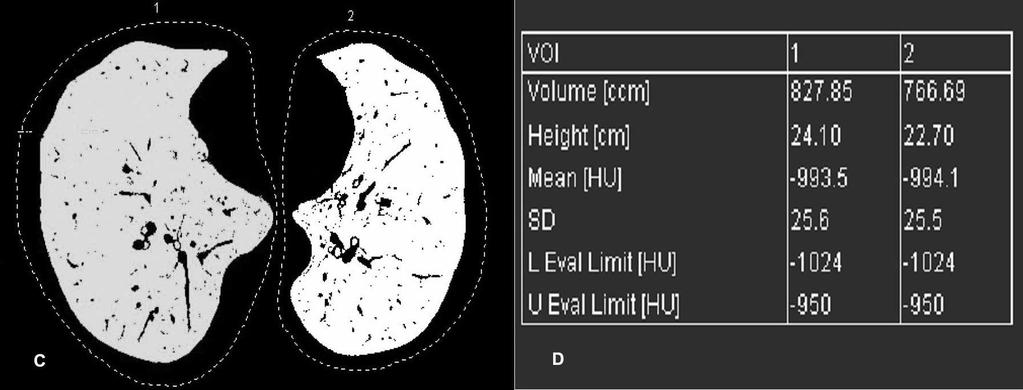 The trachea, mainstem bronchi, and air in the gastrointestinal structures were selectively removed. Figure 3. Lung volumetric assessment methods. (A) Axial CT image from a 57-year-old man with COPD.