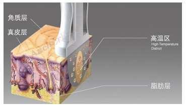 The move produces controllable heat and results in contraction of collagen and generation of new collagen and dermal