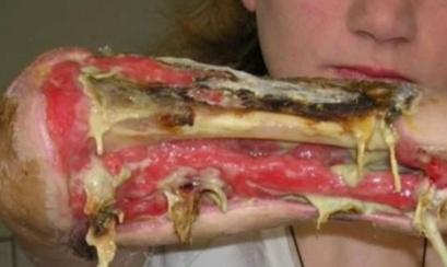Krokodil Codeine mixed with paint thinner, gasoline, red