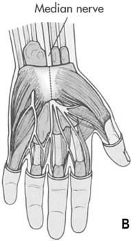 median nerve between the carpal ligament and other structures Predisposing factors Occupations involving repetitious motions of the fingers and hands Slide 35 (From Thompson,