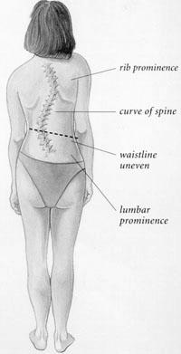 Kyphosis A rounding of the thoracic