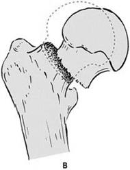 Fractures Fracture of the hip Most common type of fracture Clinical
