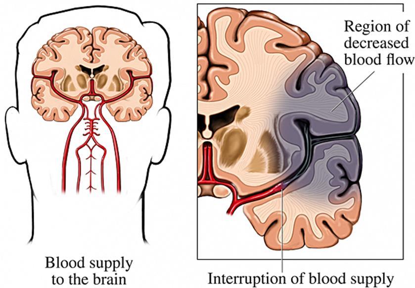 What is a Stroke? Loss or alteration of bodily functions as a result of insufficient supply of blood to the brain.