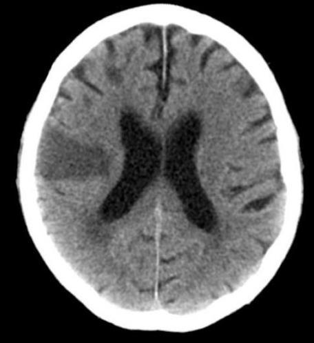 Diagnostic testing results Brain imaging wedge shaped infarct multifocal