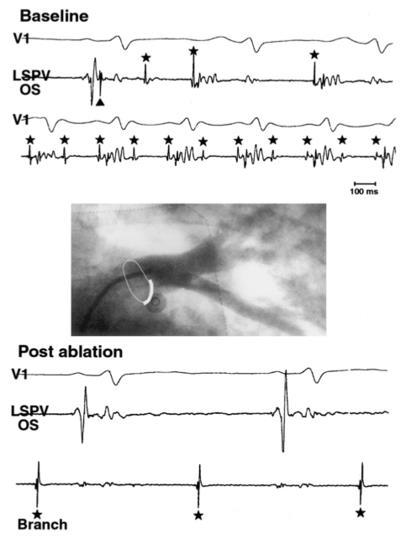 Ostial PV Isolation Atrial activation preceding PVP Discharges from PV Local PV