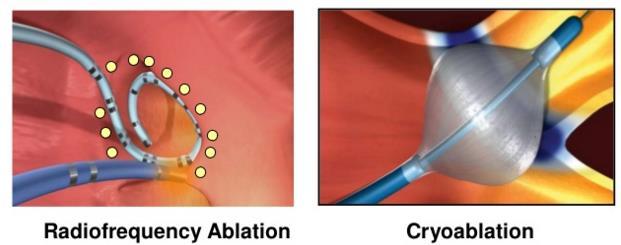 Catheter Ablation Techniques