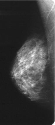 are unclear due to mammary gland effects. Breast Ultrasound examination is clearly effective in such cases.