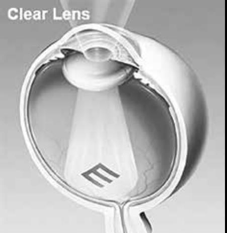 WHA T ARE C A T A R A C T S? A clear lens inside the eye helps focus light.