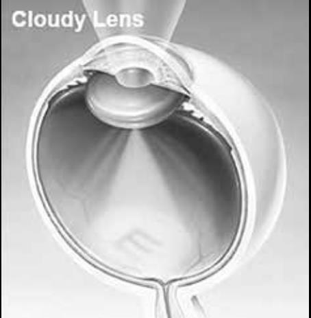 This cloudy lens is a cataract. A cataract scatters or blocks the light that passes into the eye.