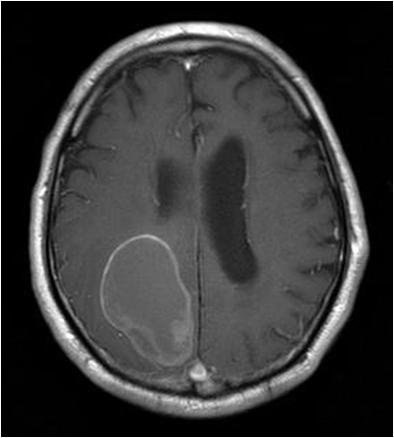 Case Report A 75-year-old man presented with a headache. Brain CT and MRI revealed a solitary cystic tumor (5 x 6 x 7 cm) in the left occipital lobe (Figure 1).