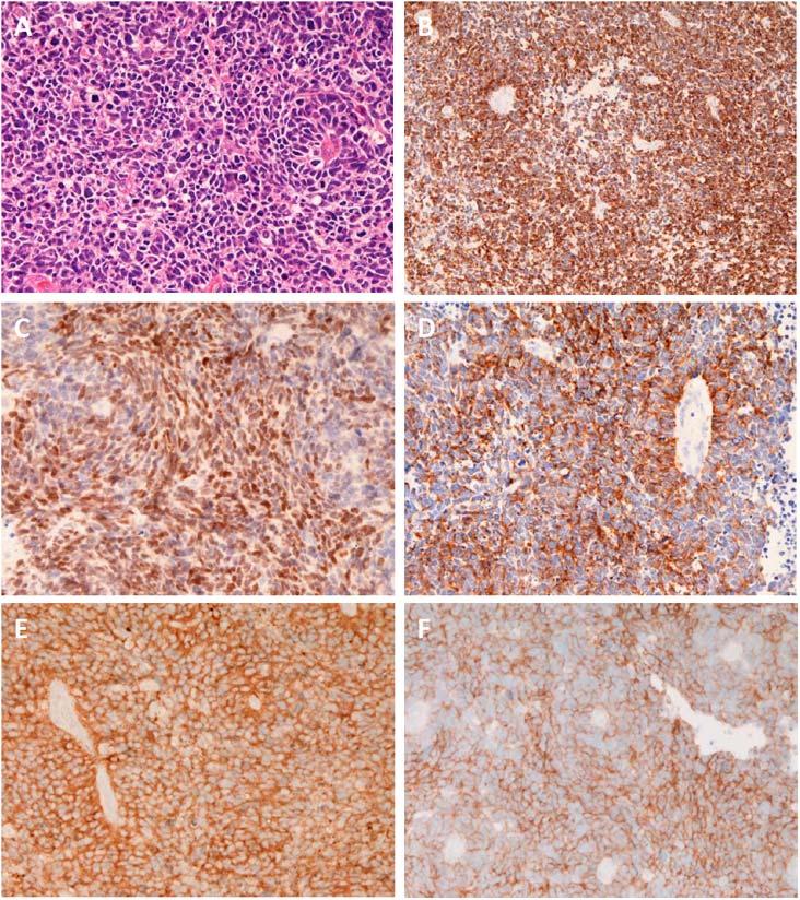 Figure 2. A. The brain tumor is a typical small cell carcinoma. HE, x100; B. The tumor is positive for cytokeratin 7. Immunostain, x100; C. The tumor is positive for cytokeratin 18.