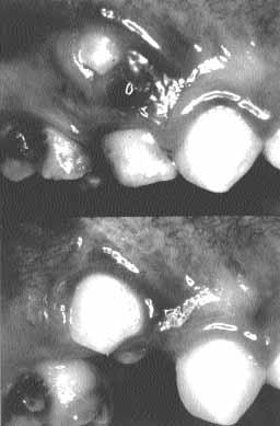 G. P. PINI PRATO ET AL. FIG. 1- Eccentric eruption of the permanent premolar (above). The entrapped gingiva is destroyed during the eruption process (below).