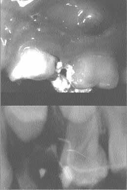 DEEP CARIES AND ECTOPIC ERUPTION 2 3 FIG.2- Deep caries in a deciduous molar (above). Radiographic appearance of periapical osteolysis (below). FIG. 3- Centric eruption: the cusp of the permanent premolar is erupting close to the corresponding deciduous molar (above).