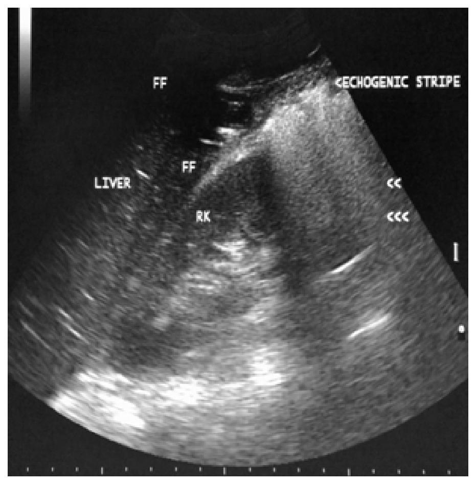 Fig 3. Sonographic Appearance of Perforation.