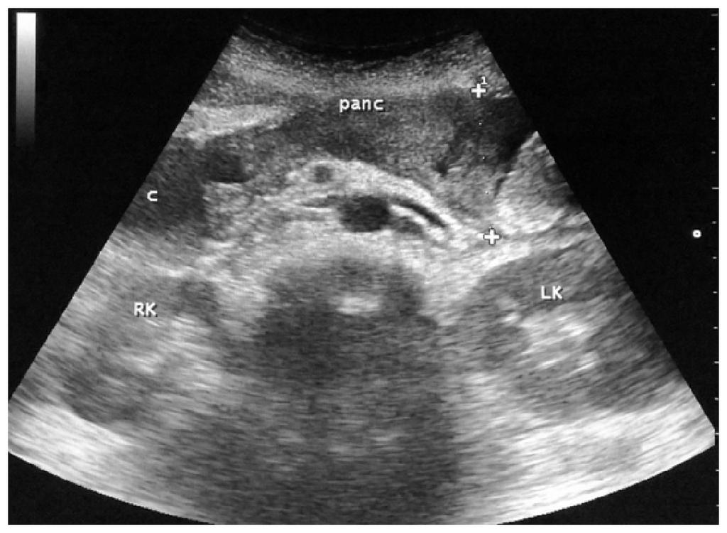 with Multiple Intrapancreatic Echopoor Areas Representing Fluid Collections.
