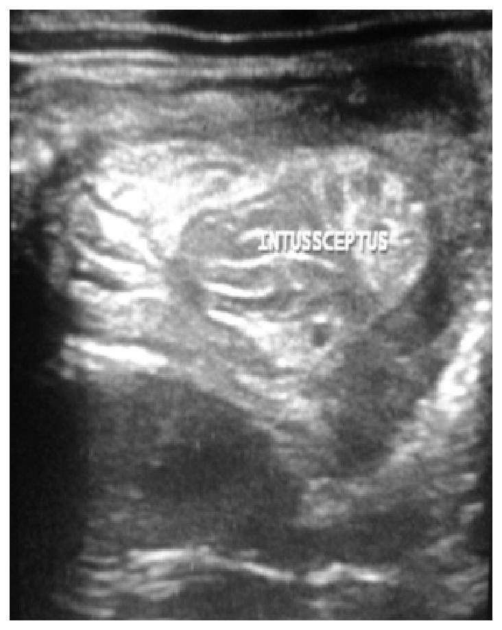 the Right Ureter Fig 8. Sonographic Appearance in Intussusception.