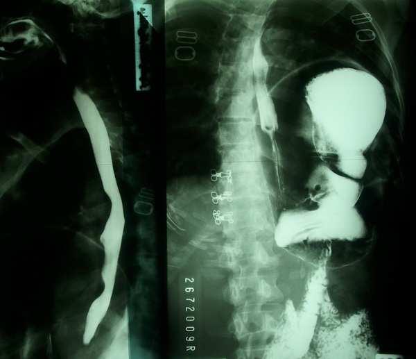 Contrast studies (Barium swallow) showing most part of stomach intratoracic with gastroesophageal junction