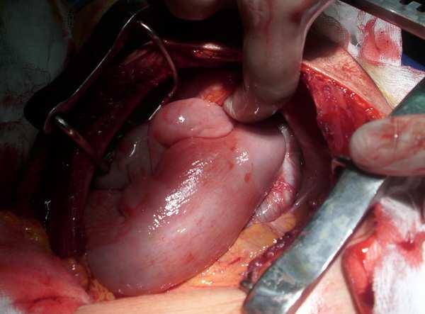 Through the left lower (7 th intercostals space) thoracotomy finding stomach, colon, part of left lobe of liver, omentum & part of small bowel herniation through the defect with