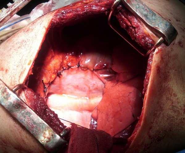 5 Intraoperative show,stomach, small bowel,colon herniation through the defect.