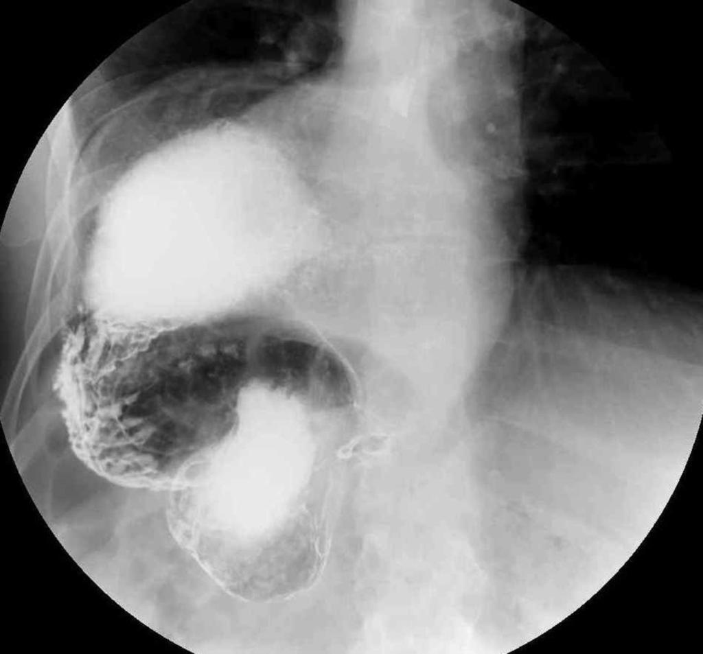 Fig. 3: Hiatal hernia