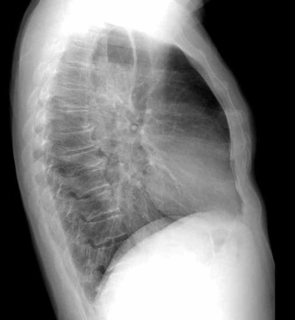 Fig. 12: Achalasia, chest X-Ray