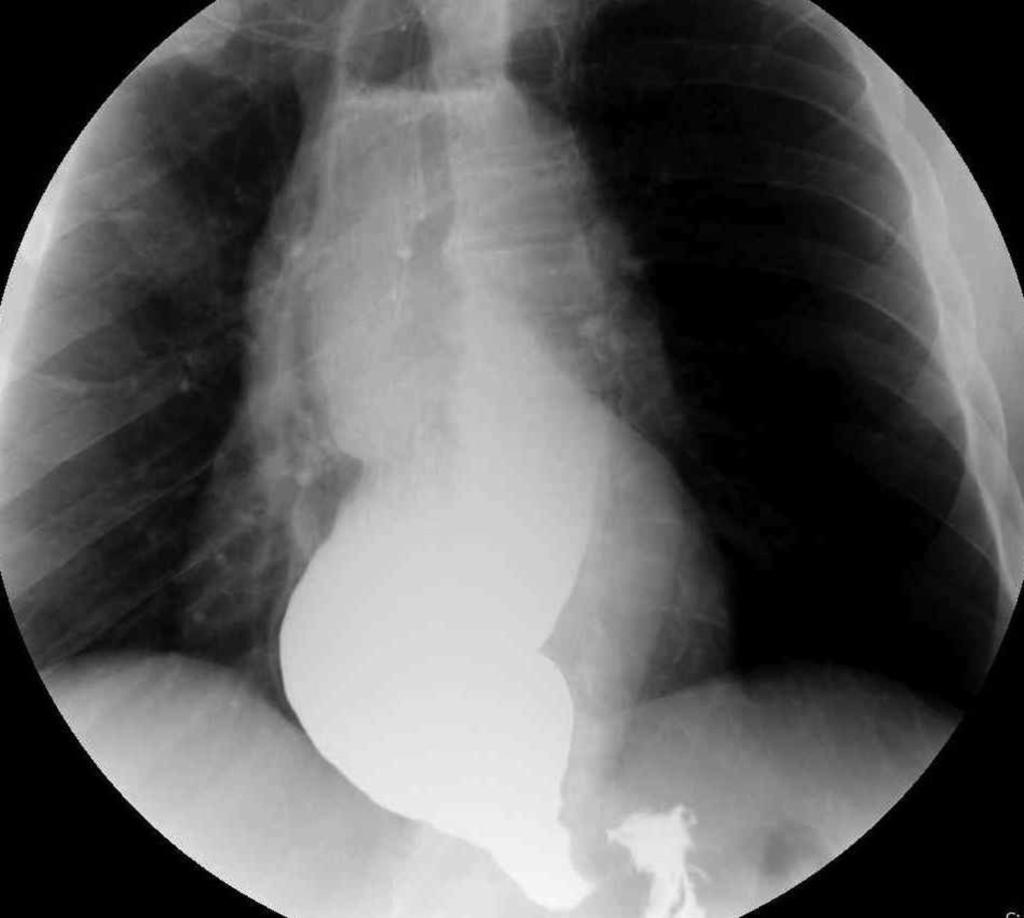 Fig. 13: Achalasia with