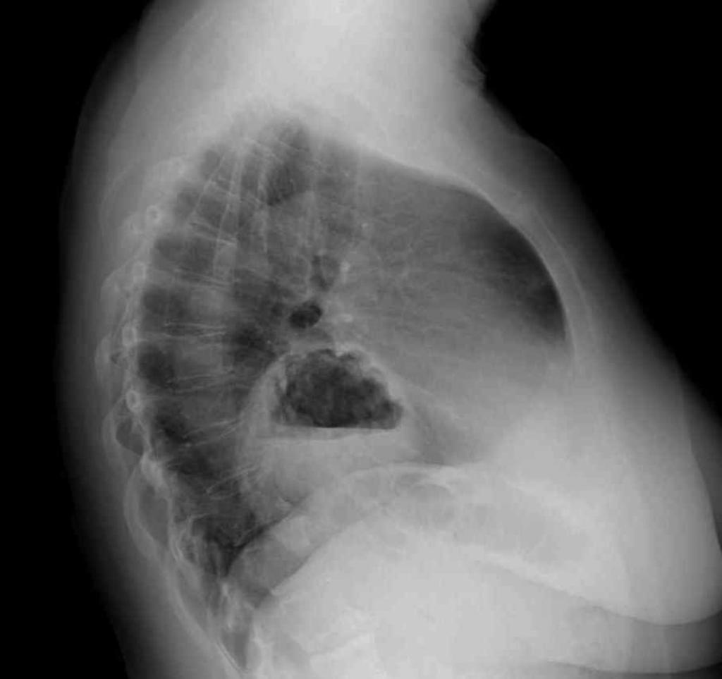Fig. 2: Hiatal hernia with