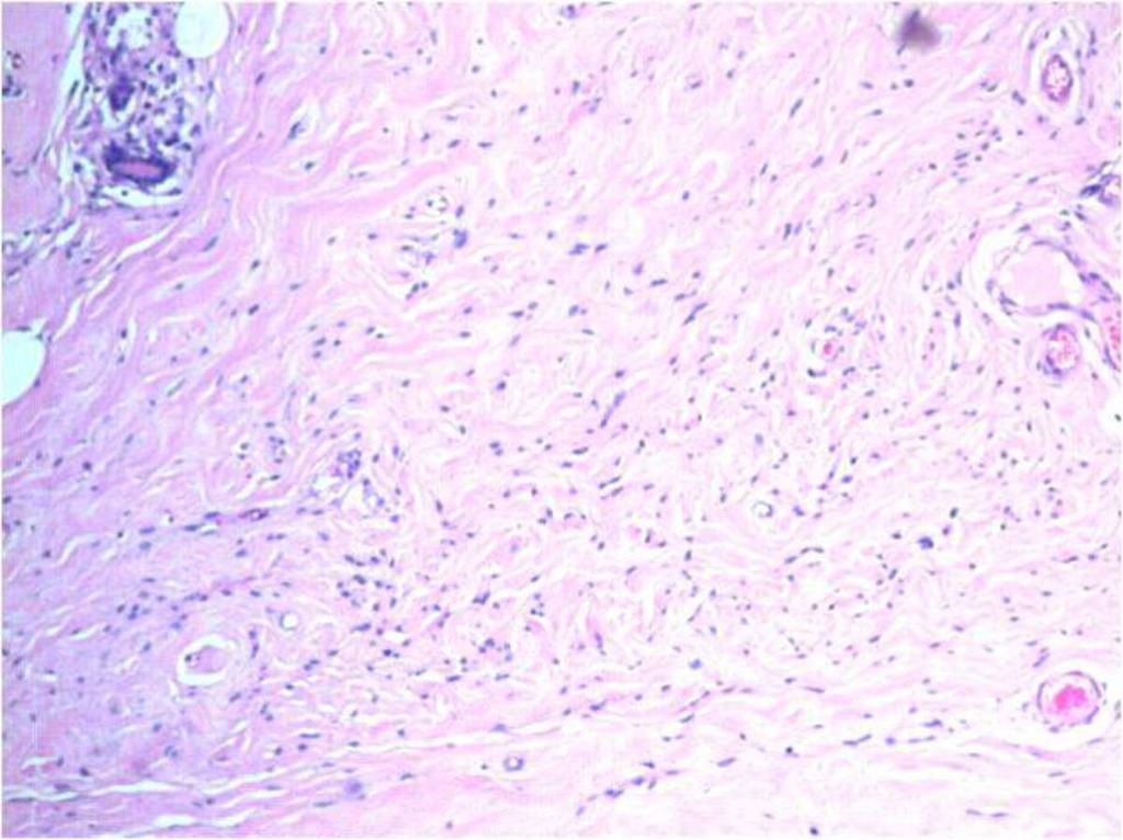 Fig. 0: Histological specimen x4 H&E stain, Bland spindle cells appear