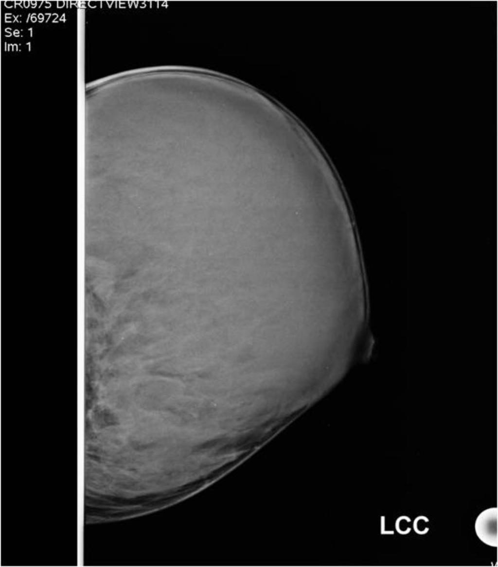 Fig. 0: Craniocaudal view of the left breast with diffusely increased