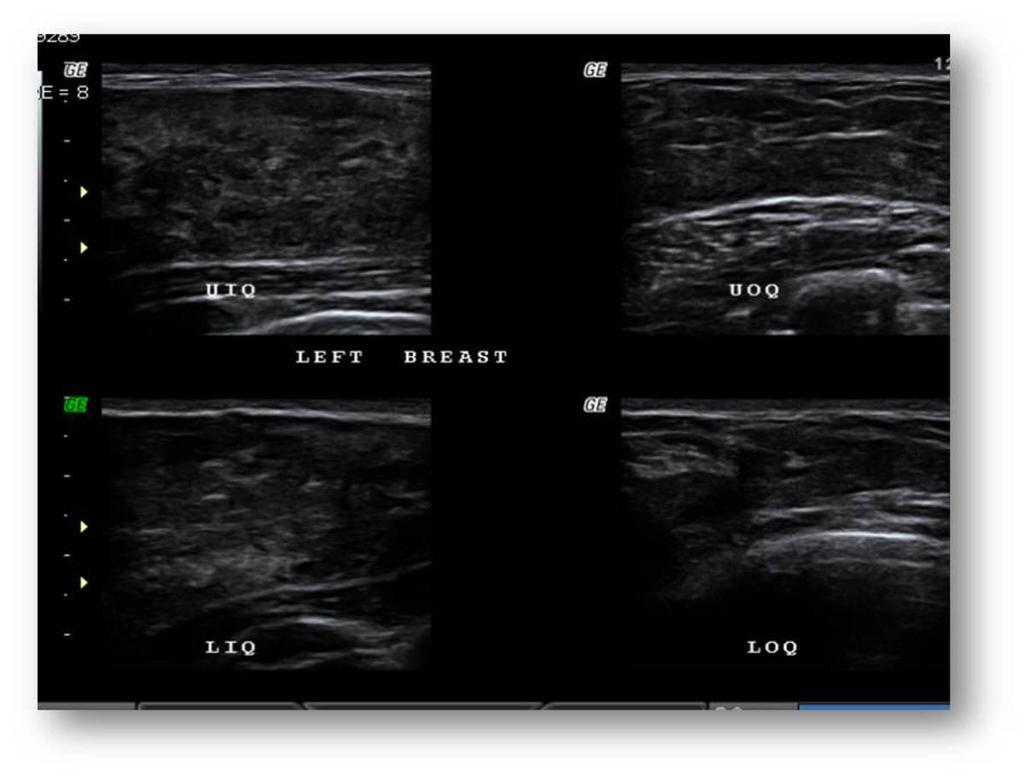 Fig. 0: Ultrasound of the all four quadrants of the left breast shows diffuse thickening