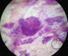 Group 1B: Contiguous and Extensive Disease on Histology 75 3D