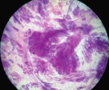 pairs ofthe additional in situ carcinoma foci, 10 15 mmfrom