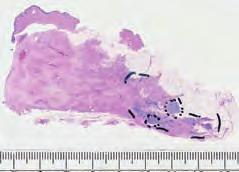 74 One or Two Clusters of Crushed Stone like Calcifications on the Mammogram Produced by Malignancy Example 2.