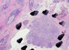 The pathologist has marked the extent of the disease and the invasive foci (dotted lines).