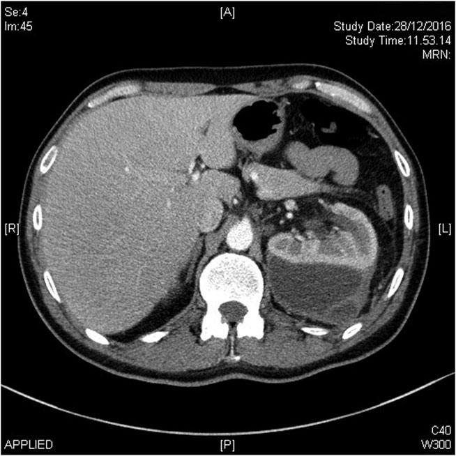 54 FIG. 2. CT scan showing subcapsular kidney collection after second-look percutaneous nephrolithotomy. No external or retroperitoneal extravasation is observed.