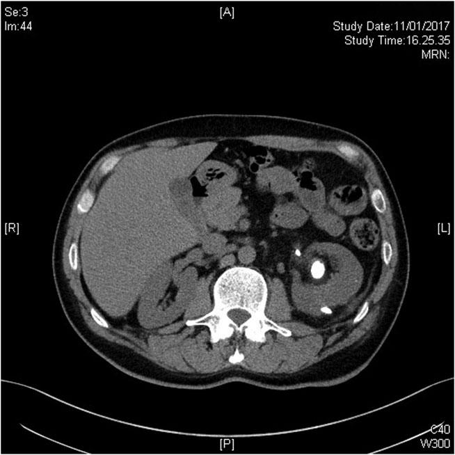 55 FIG. 4. CT scan showing subcapsular kidney collection healing after 7 days of drainage. survey has mentioned most of the PCNL complications and relative management.