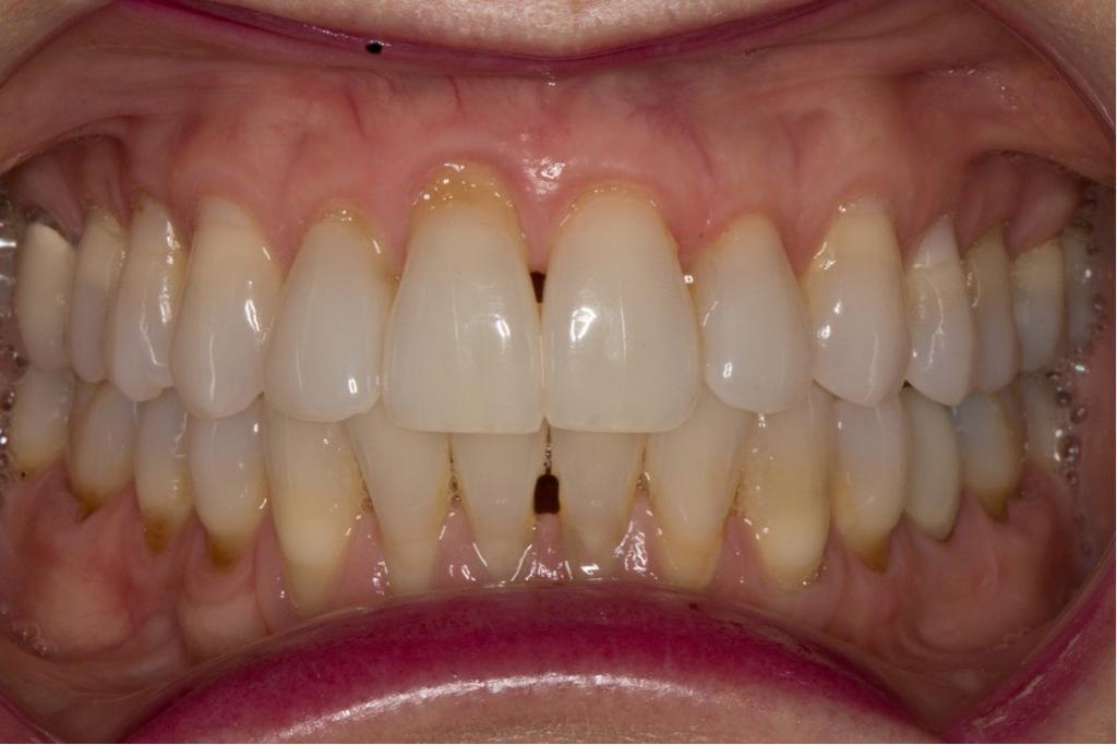 POSTERIOR OPEN-BITE OCCLUSION Patients managing an airway problem with night-time use of a mandibular