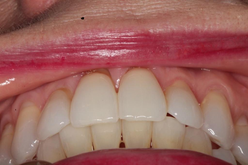 POSTERIOR OPEN-BITE OCCLUSION Heavy anterior tooth contact prior to splint insertion Patients with posterior open bites experience repetitive occlusal trauma to the anterior teeth.