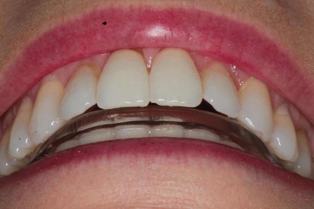POSTERIOR OPEN-BITE OCCLUSION As the PDL of the front teeth tightens, the upper incisors will yet again make an impact against the leading edge of the splint.