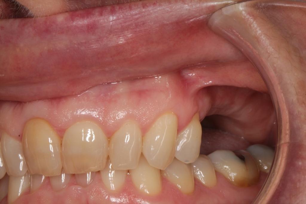 INCOMPLETE OCCLUSAL SCHEMES Missing teeth presents a real challenge for allowing the teeth to provide lateral